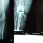 Ρομποτική ολική αρθροπλαστική γόνατος